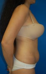 Abdominoplasty or Tummy Tuck