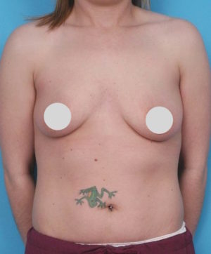 Breast Augmentation Before and After Photos