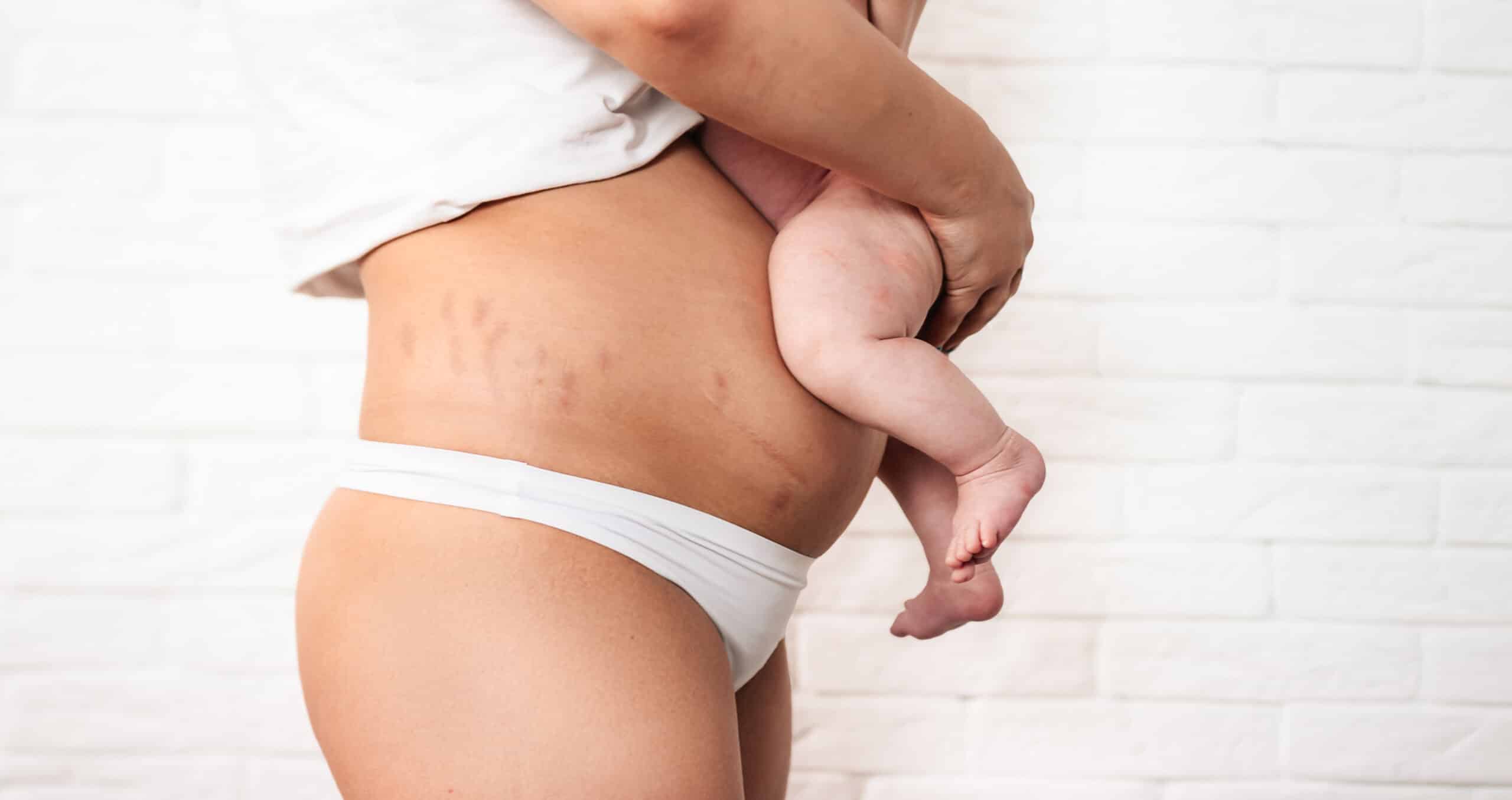 Fitness and Mommy Makeover: Maintaining Results Long-Term
